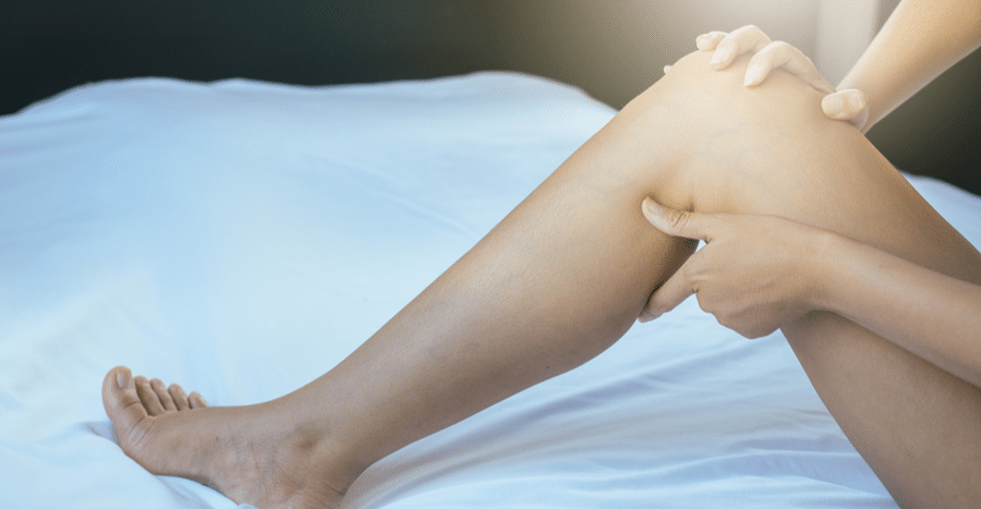 Sclerotherapy, Sclerotherapy